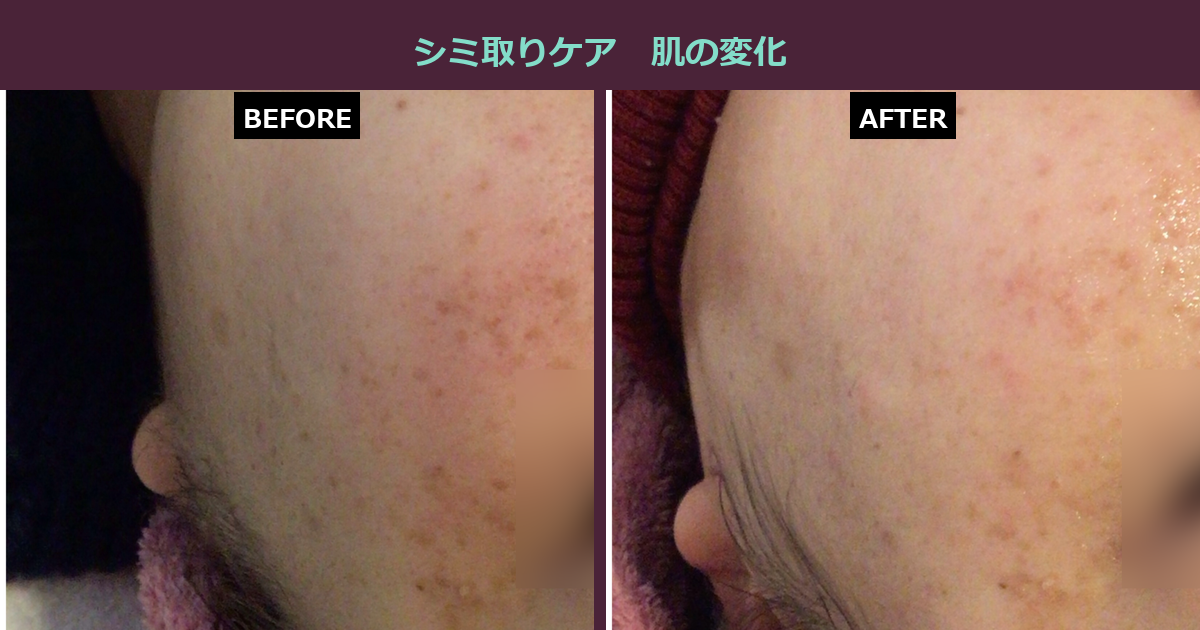 【三軒茶屋フェイシャル】そのシミ、このままで大丈夫ですか?