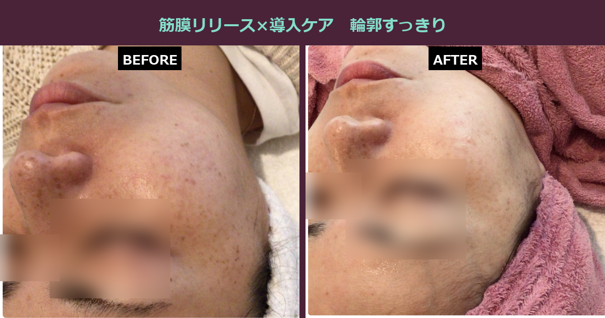 【三軒茶屋フェイシャル】フェイスラインのもたつき、気になりませんか?