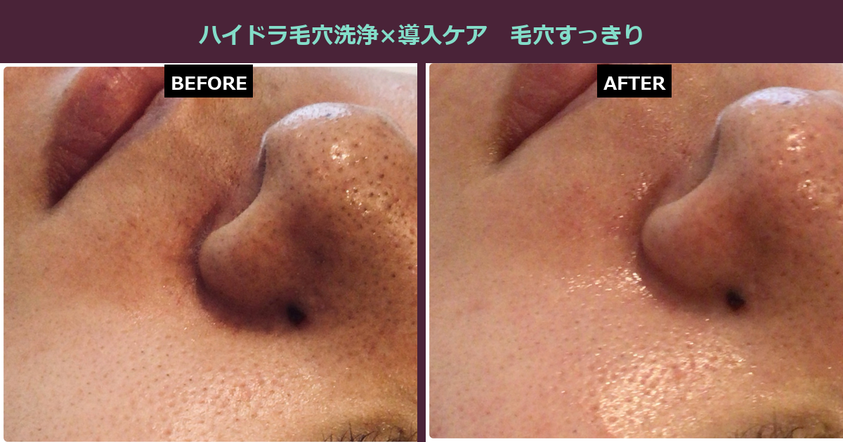 【三軒茶屋フェイシャル】鼻のざらつき、指で触って気になりませんか?