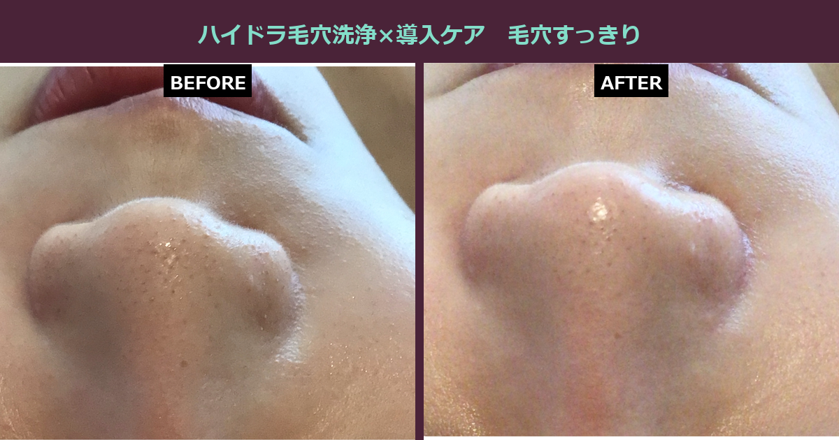 【三軒茶屋フェイシャル】大人女性に増える毛穴悩み、心当たりありませんか?