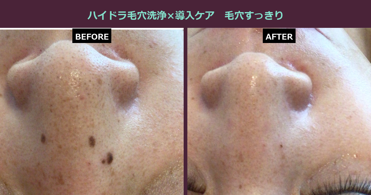【三軒茶屋フェイシャル】鼻まわりの毛穴汚れ、見て見ぬふりをしていませんか?