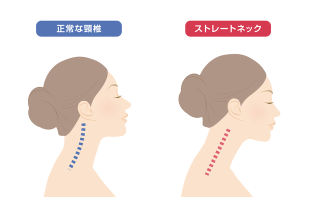 春日市在住　U様の首痛・ストレートネックが改善いたしました。