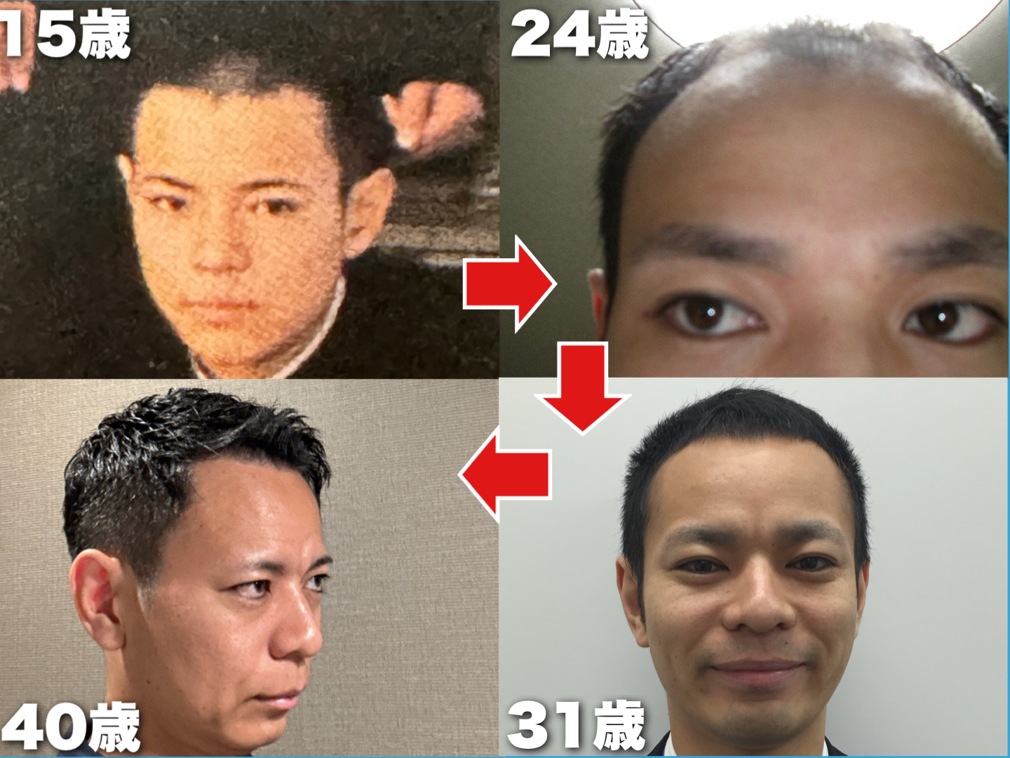 AGA治療を15年行った結果