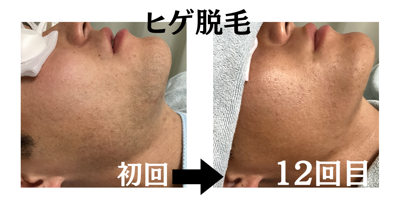 ヒゲ脱毛は何回で効果が出るの?正直に答えます