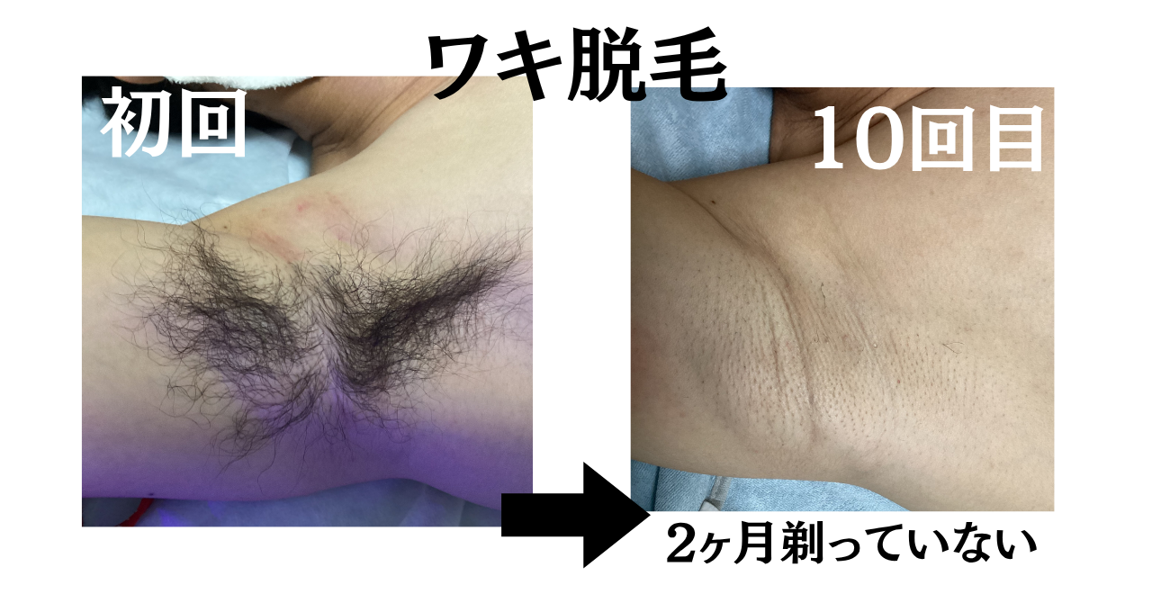 女性は「まず1回」、男性は「実は迷う」。ワキ脱毛¥500キャンペーンの理由
