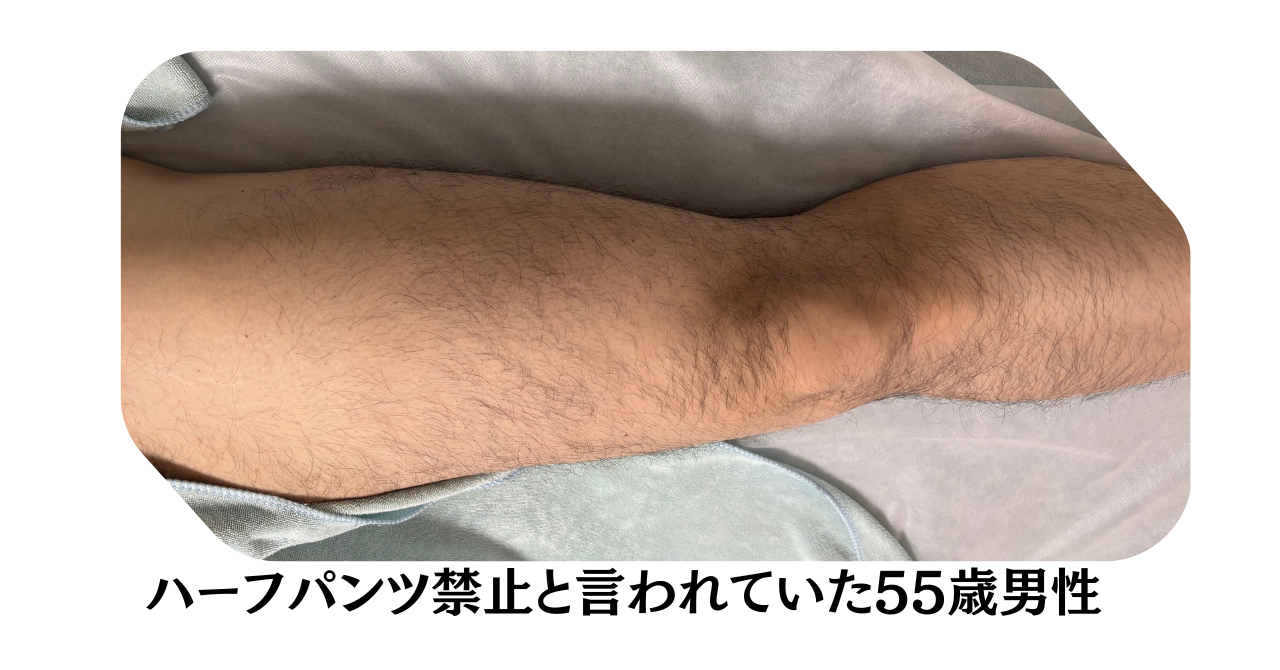 娘に「ハーフパンツ禁止」と言われた50代男性が、脱毛を始めた話