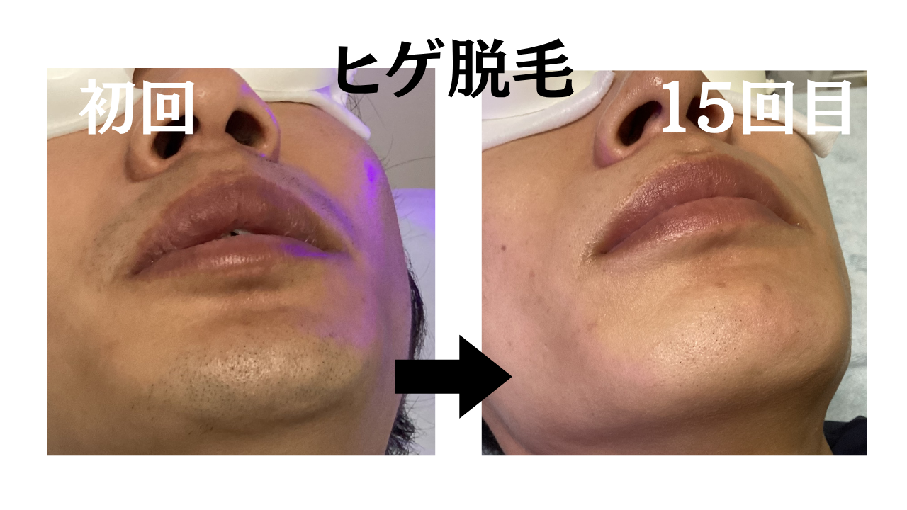 ヒゲ脱毛は15回でどれくらい変わる?20代男性のビフォーアフター