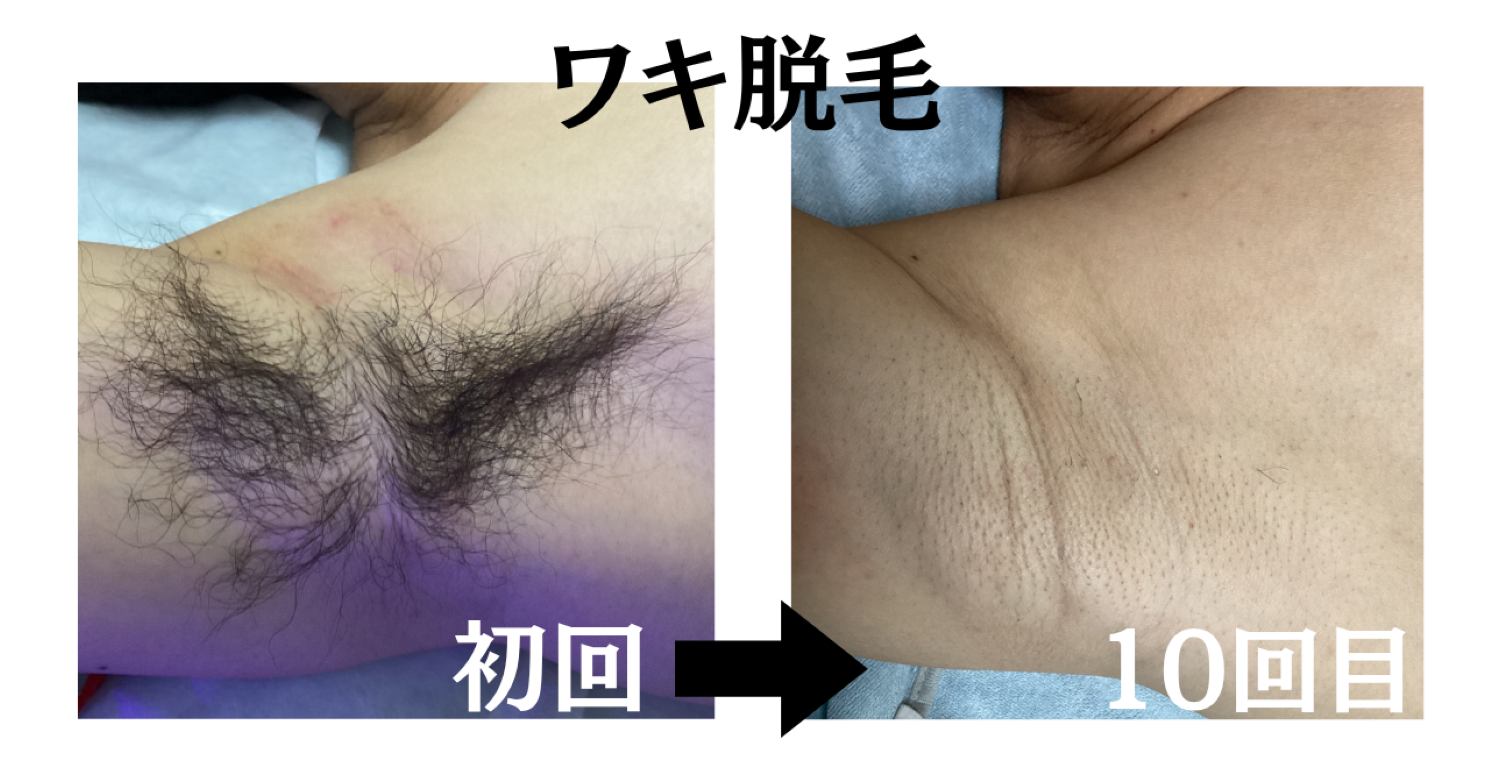ワキ脱毛は何回で自己処理いらずに?30代男性のビフォーアフター