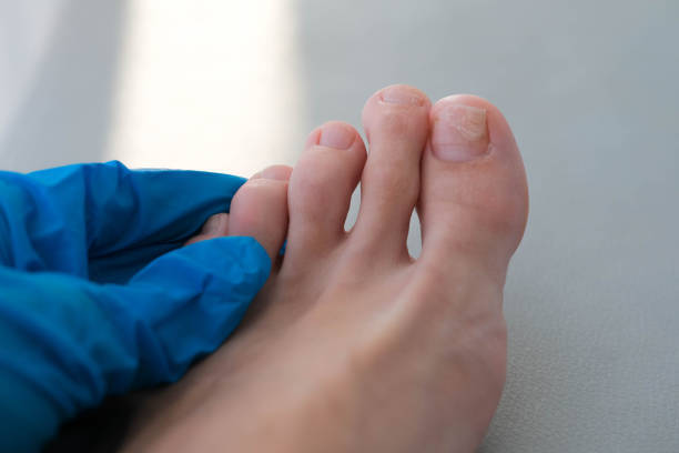 その痛み、実は巻き爪じゃないかも？「陥入爪」との決定的な違いと正しい対処