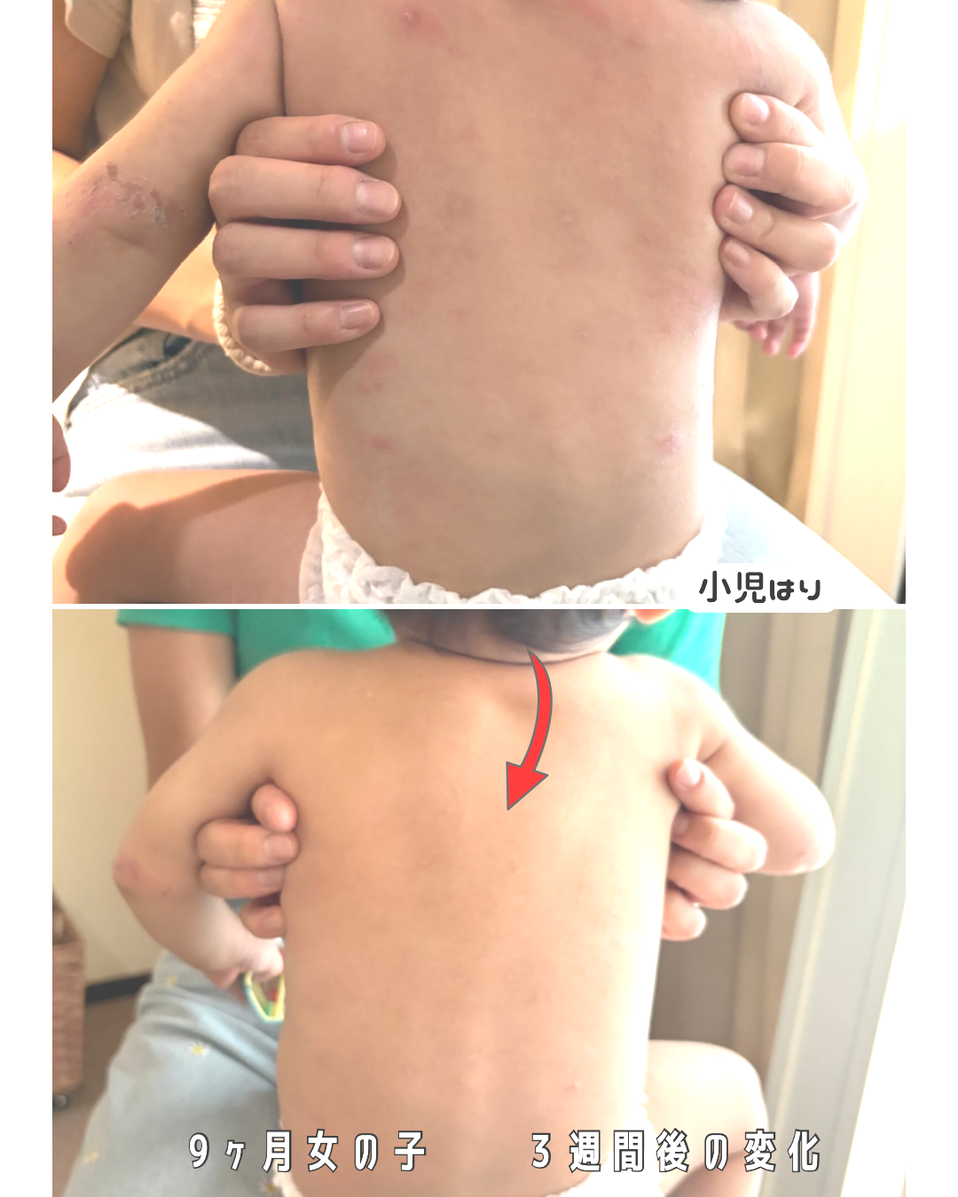 ゼロゼロ　夜深く寝ない　乾燥肌　よだれかぶれ　発達ゆっくり 生後9ヶ月女の子　2025/5