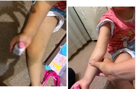 7ヶ月どんどん増える水いぼ　2025/5