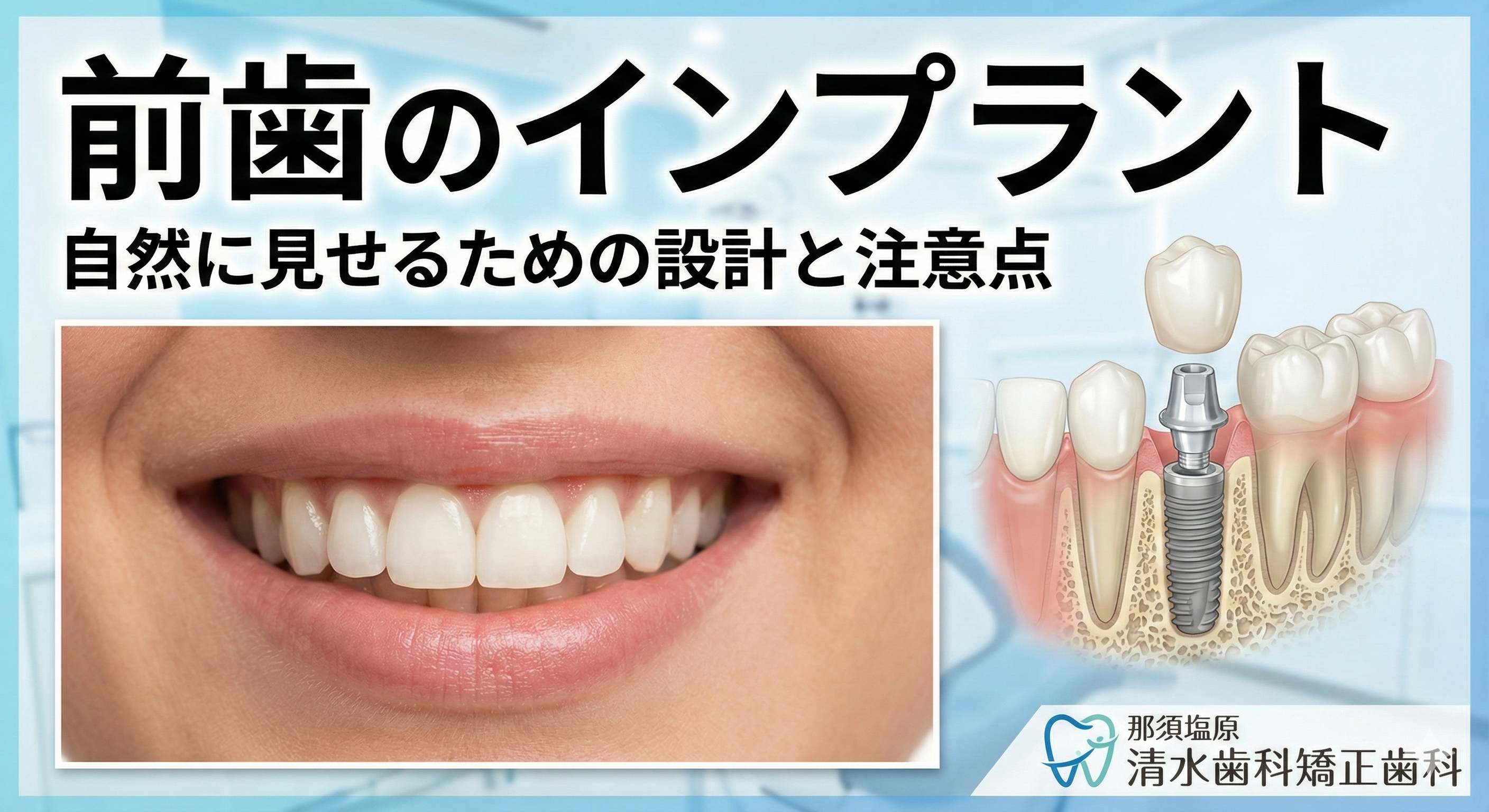 前歯のインプラント｜自然に見せるための設計と注意点（那須塩原）