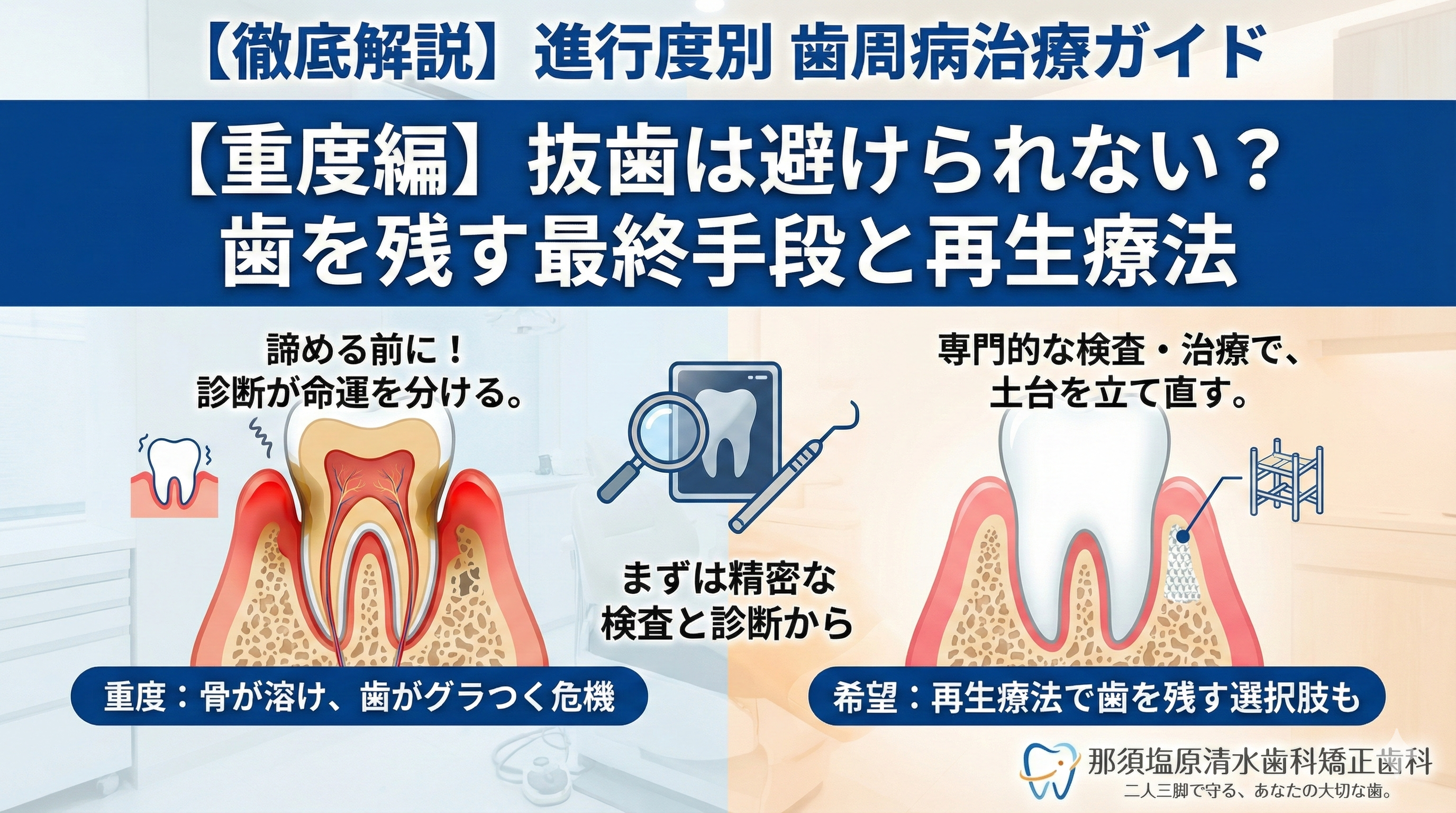 【徹底解説】進行度別・歯周病の症状と治療ガイド：重度歯周病編（抜歯は避けられない？歯を残すための最終手段と再生療法）