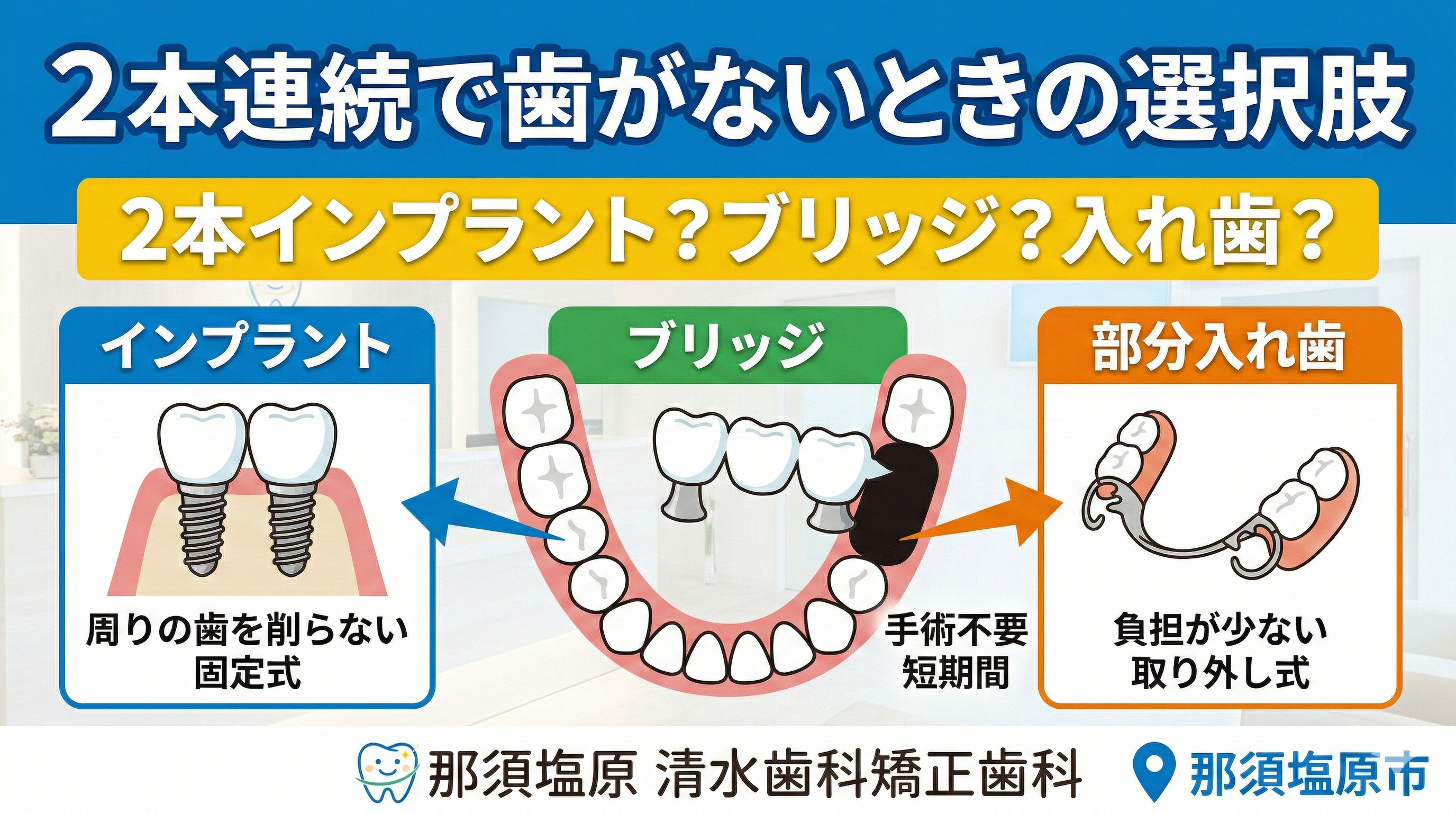 2本連続で歯がないときの選択肢｜2本インプラント？ブリッジ？入れ歯？（那須塩原）