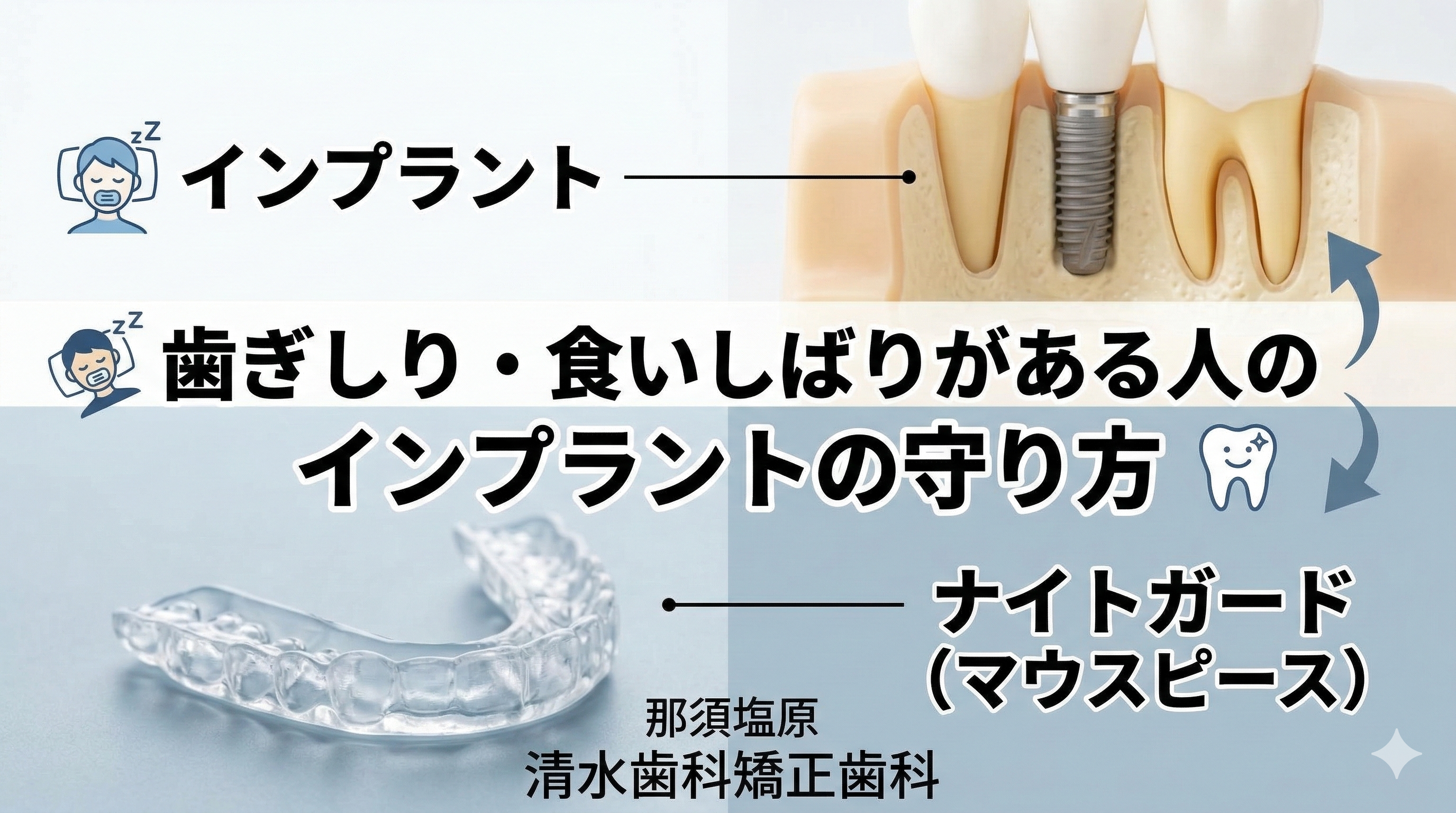 歯ぎしりがある人のインプラント｜ナイトガードは必要？守り方の現実解（那須塩原）