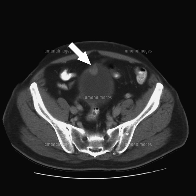 Bladder Cancer Ct の写真素材 イラスト素材 アマナイメージズ