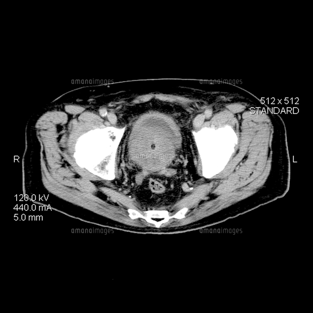 Ct Prostate Cancer 01808030873 の写真素材 イラスト素材 アマナイメージズ