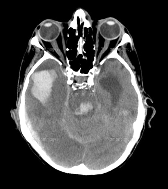Massive Intracranial Hemorrhage Ct Scan の写真素材 イラスト素材 アマナイメージズ