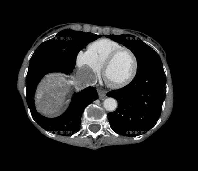 Smooth Muscle Cancer Ct Scan の写真素材 イラスト素材 アマナイメージズ