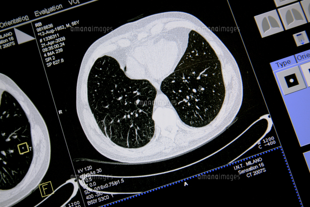 Axial Lung Ct Scan の写真素材 イラスト素材 アマナイメージズ