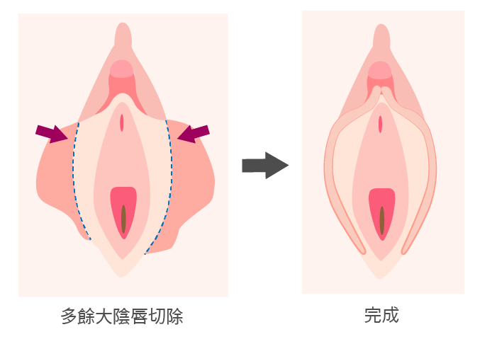 高雄陰唇手術,高雄醫美,高雄私密處手術,高雄醫美推薦.png