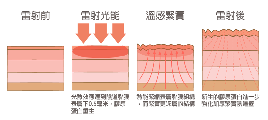 私密手術,G緊,微創處女膜修補術,陰道緊縮術,陰道緊實注射,小陰唇美化術,大陰唇整形術.