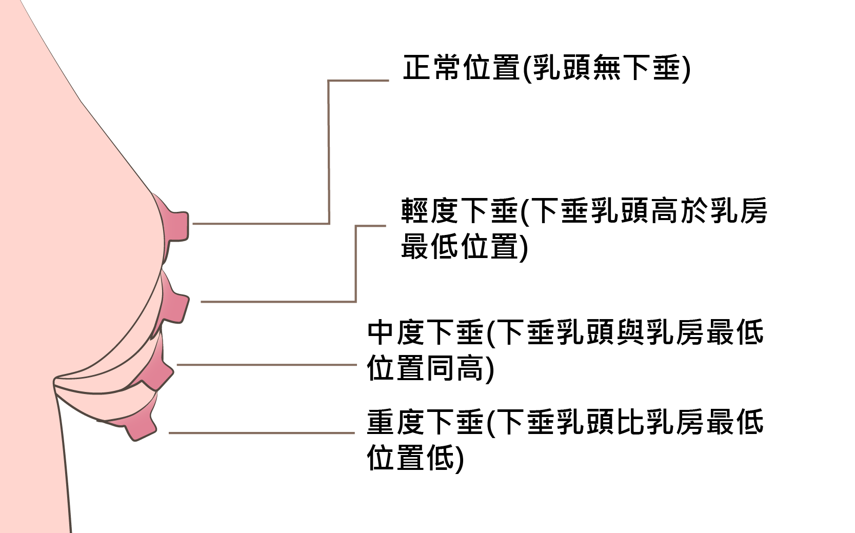 乳房下垂手術 高雄醫美,高雄自體脂肪隆乳,高雄抽脂.高雄隆乳推薦 抽脂,抽脂手術,抽脂推薦,