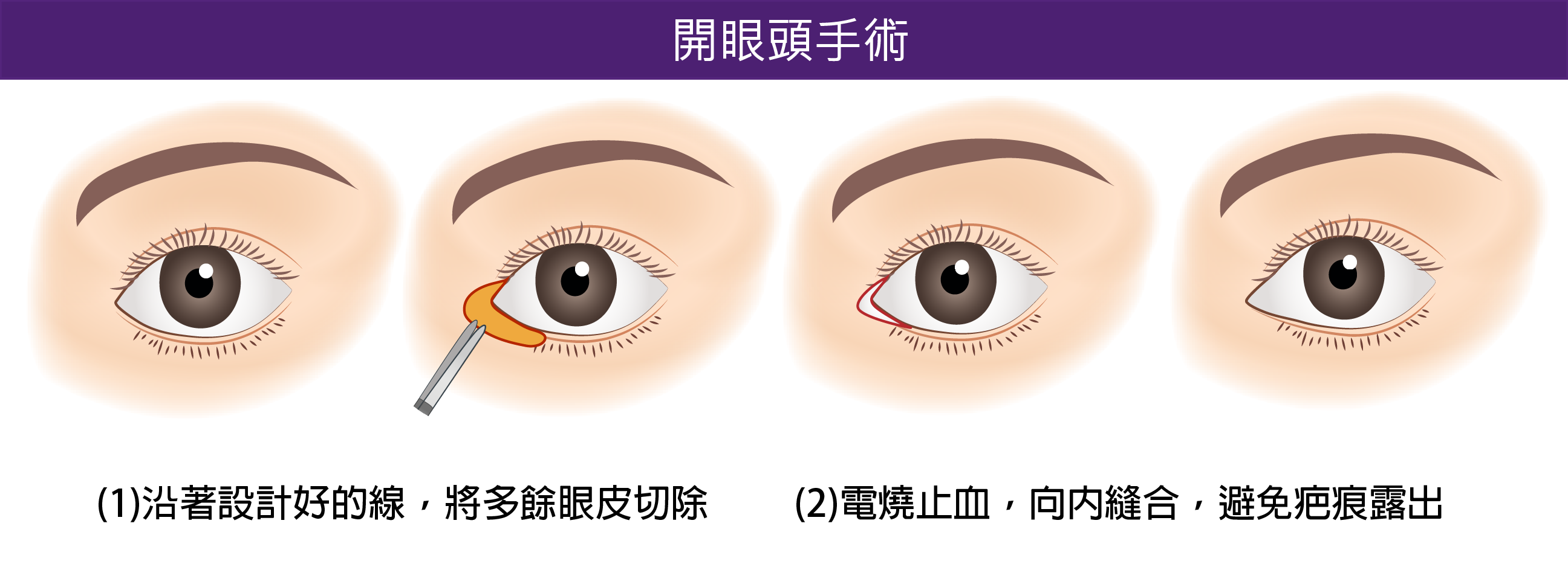 專業開眼頭手術,高雄整形,高雄醫美專業於抽脂,雙眼皮,眼袋,隆乳,拉皮,隆鼻,墊下巴,微整,雷射以及美容保養