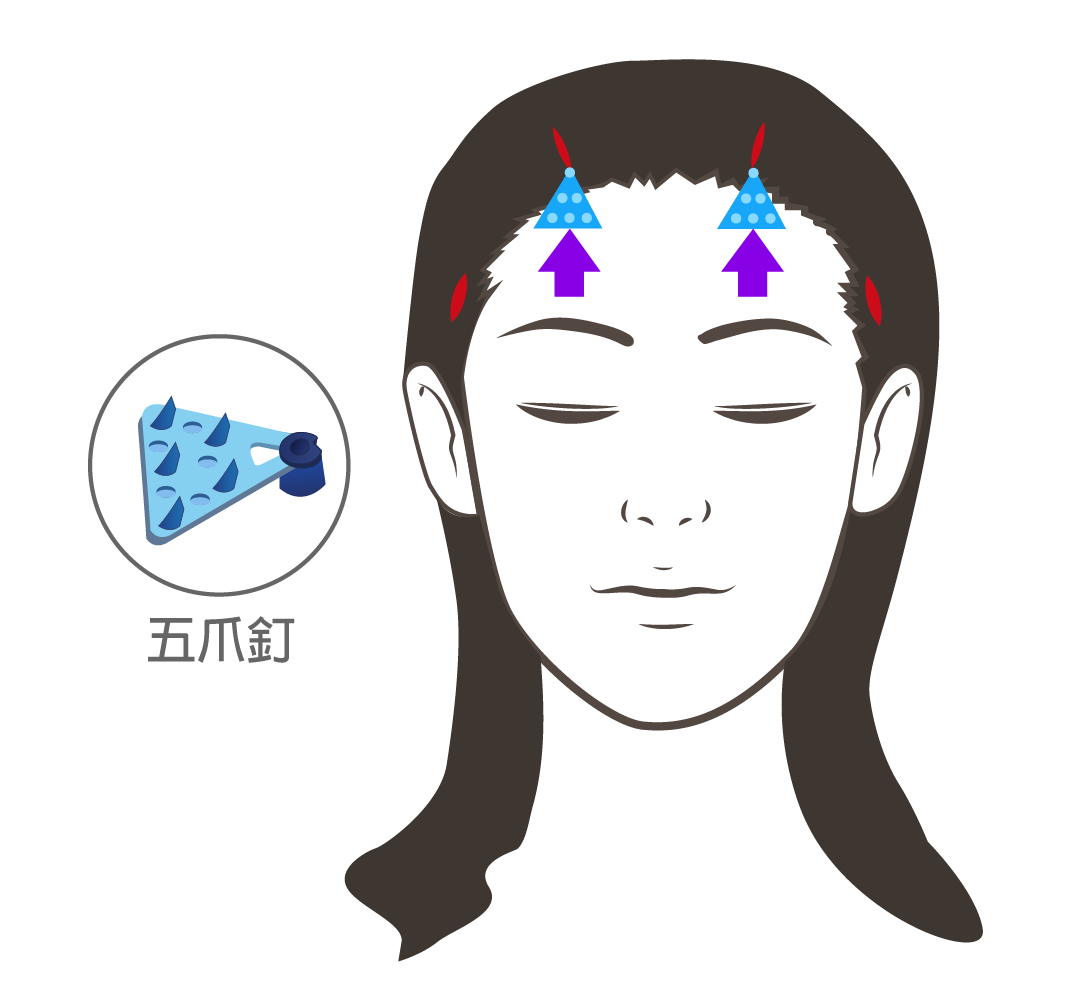 高雄拉皮手術,高雄拉皮手術推薦,專業拉皮,拉皮費用價格,前額拉皮,全臉拉皮