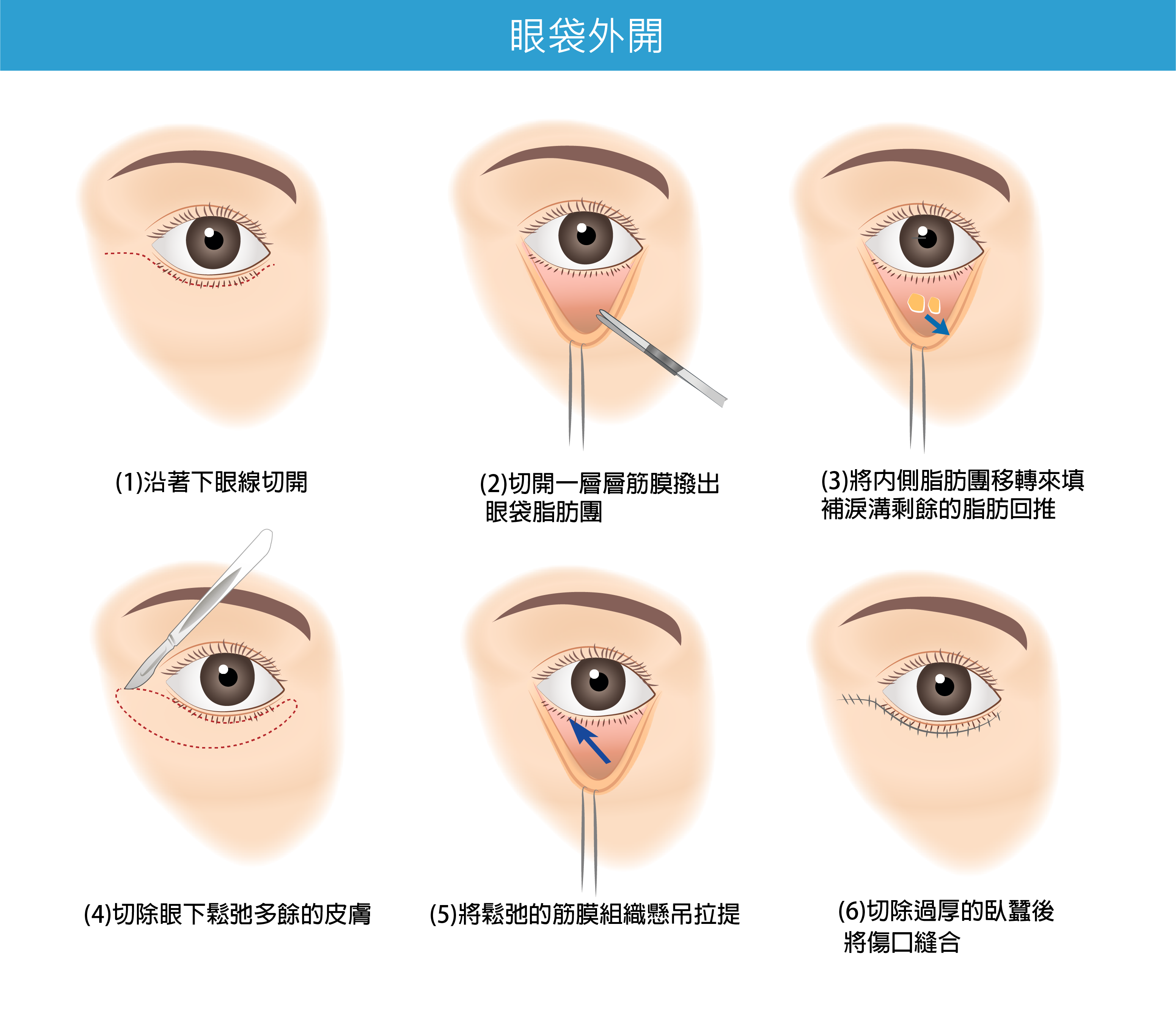高雄眼袋手術推薦,高雄眼袋手術價格,高雄眼袋手術推薦,眼袋外開,醫師推薦,眼袋內開