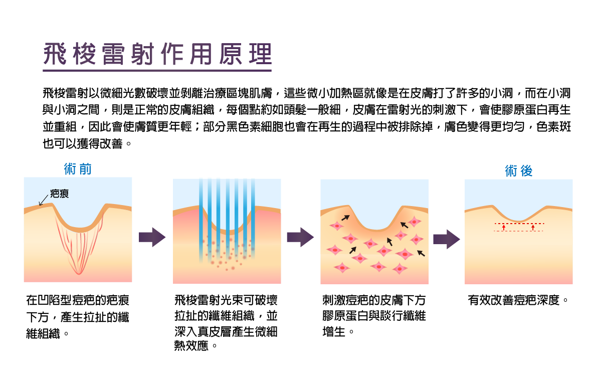 飛梭雷射,淨膚雷射.杏仁酸,保濕,清痘痘,縮毛孔,淡斑 飛梭雷射,微點飛梭雷射,凹洞,皺紋,疤痕,痘疤,磨皮,毛孔粗大,生長紋,細血管絲,色素不均,飛梭,凹疤