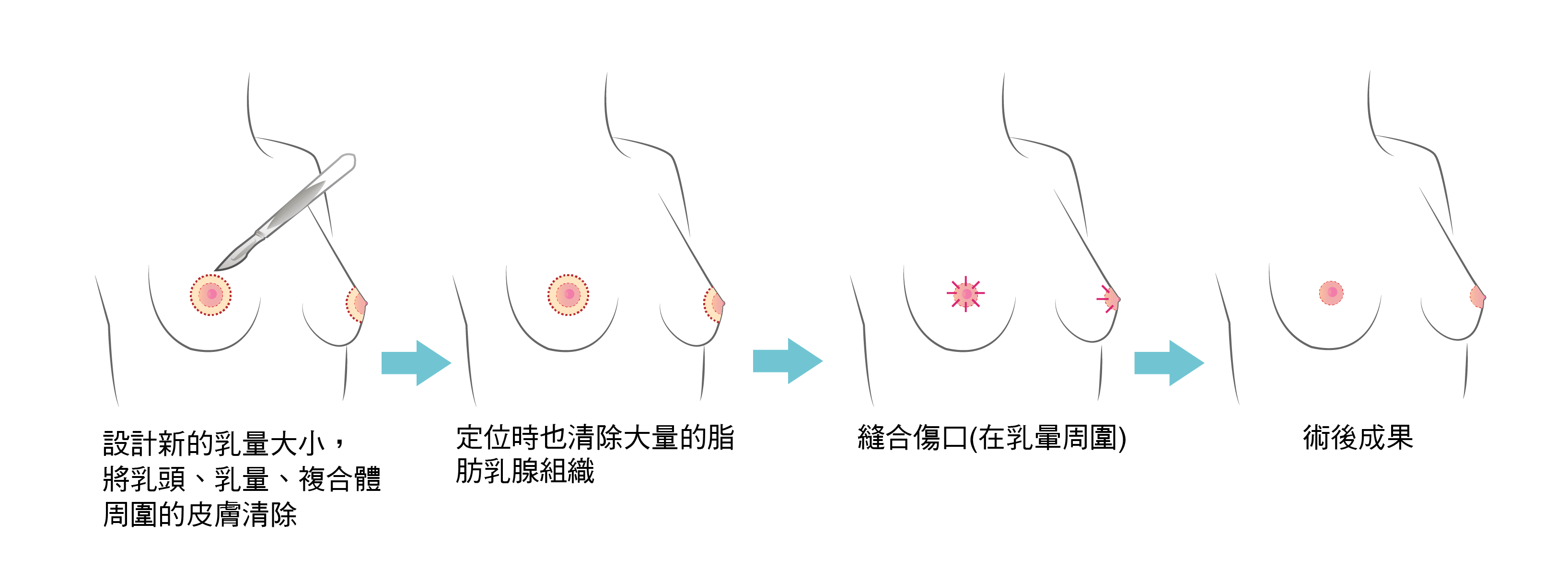 高雄醫美 乳暈縮小 乳暈縮小術 乳暈縮小價格