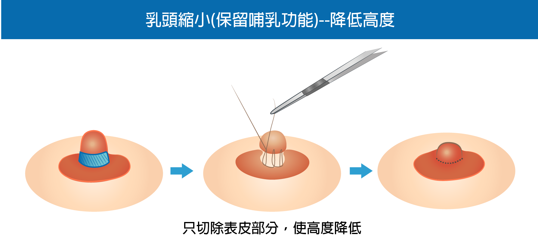 高雄乳頭縮小,乳頭矯正,乳頭縮小價格,高雄胸部整形,男性女乳,高雄醫美