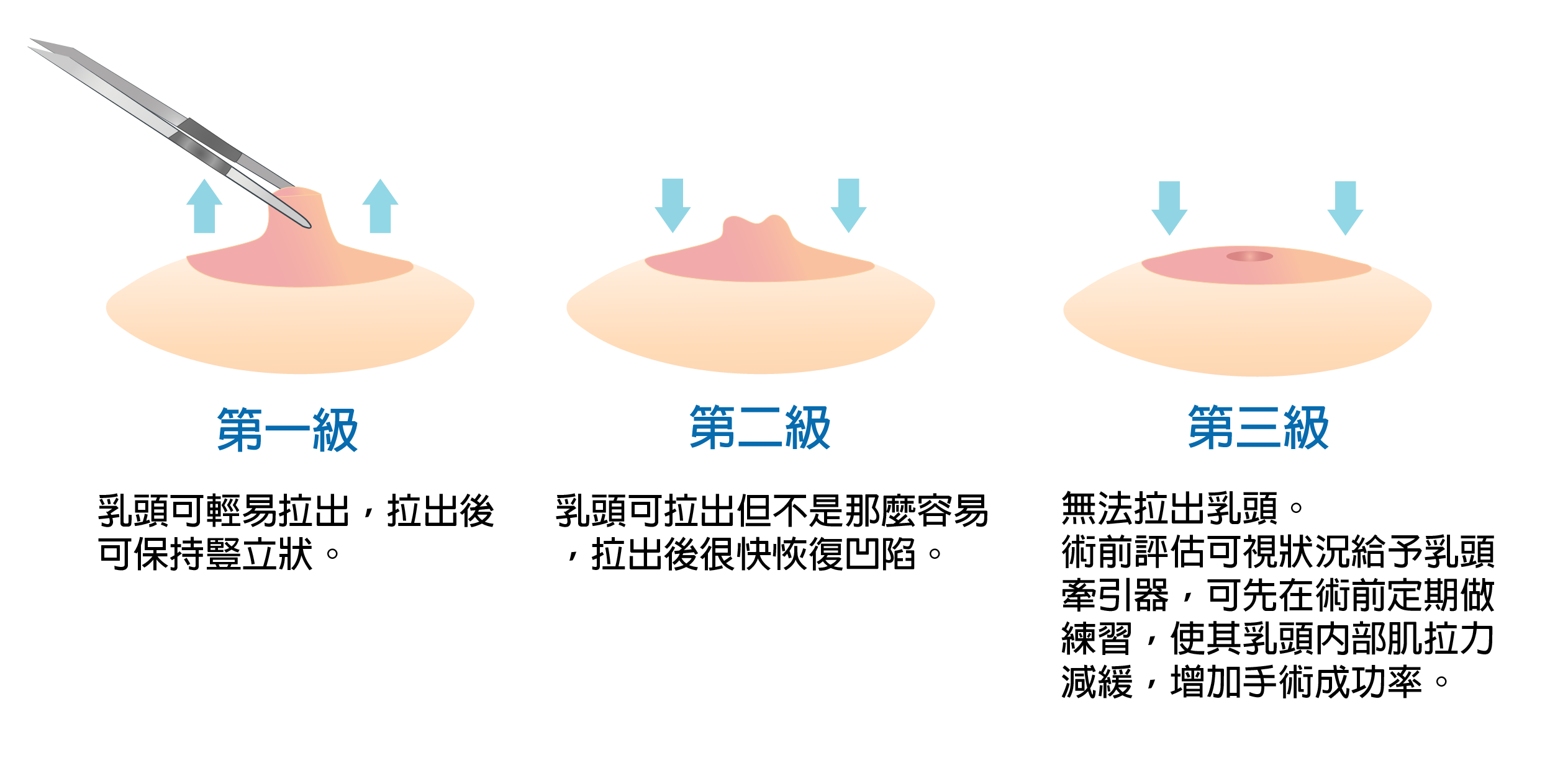 凹乳頭.高雄醫美,高雄自體脂肪隆乳,高雄抽脂.高雄隆乳推薦 抽脂,抽脂手術,抽脂推薦 乳頭凹陷