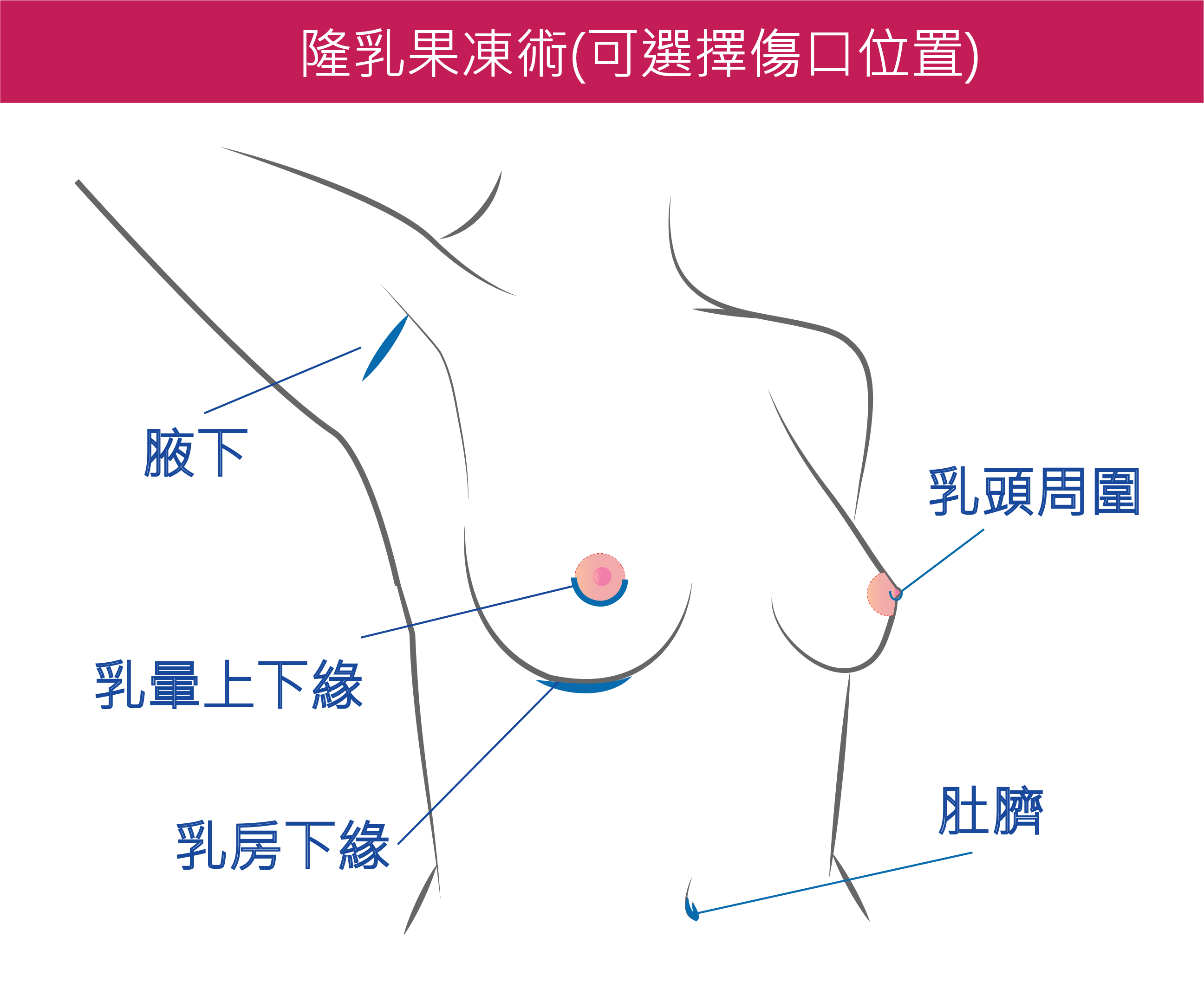 隆乳,隆乳手術,隆乳推薦,隆乳費用,果凍矽膠隆乳,小S隆乳,隆乳費用,隆乳心得,隆乳照片,隆乳按摩,自體脂肪隆乳,隆乳案例