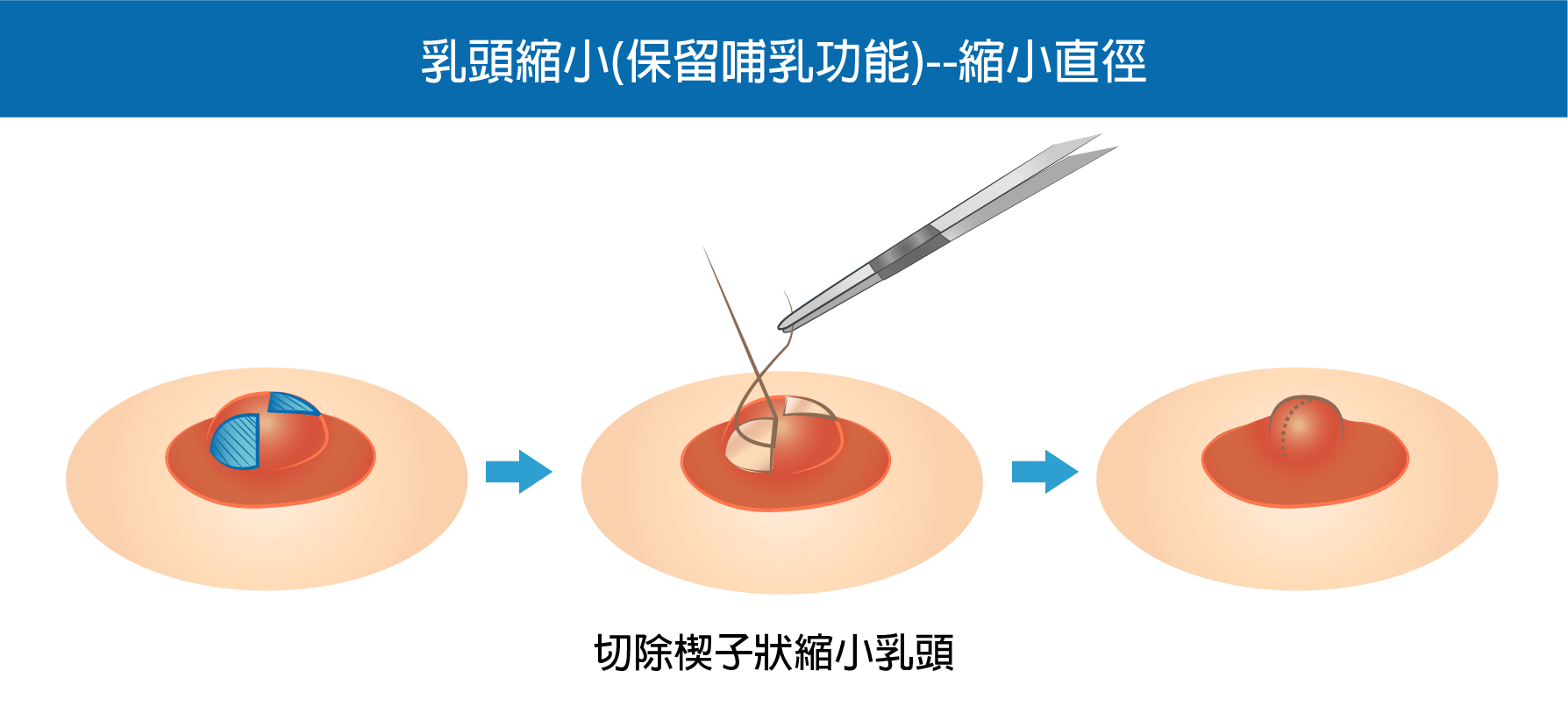 高雄乳頭縮小,乳頭矯正,乳頭縮小價格,高雄胸部整形,男性女乳,高雄醫美