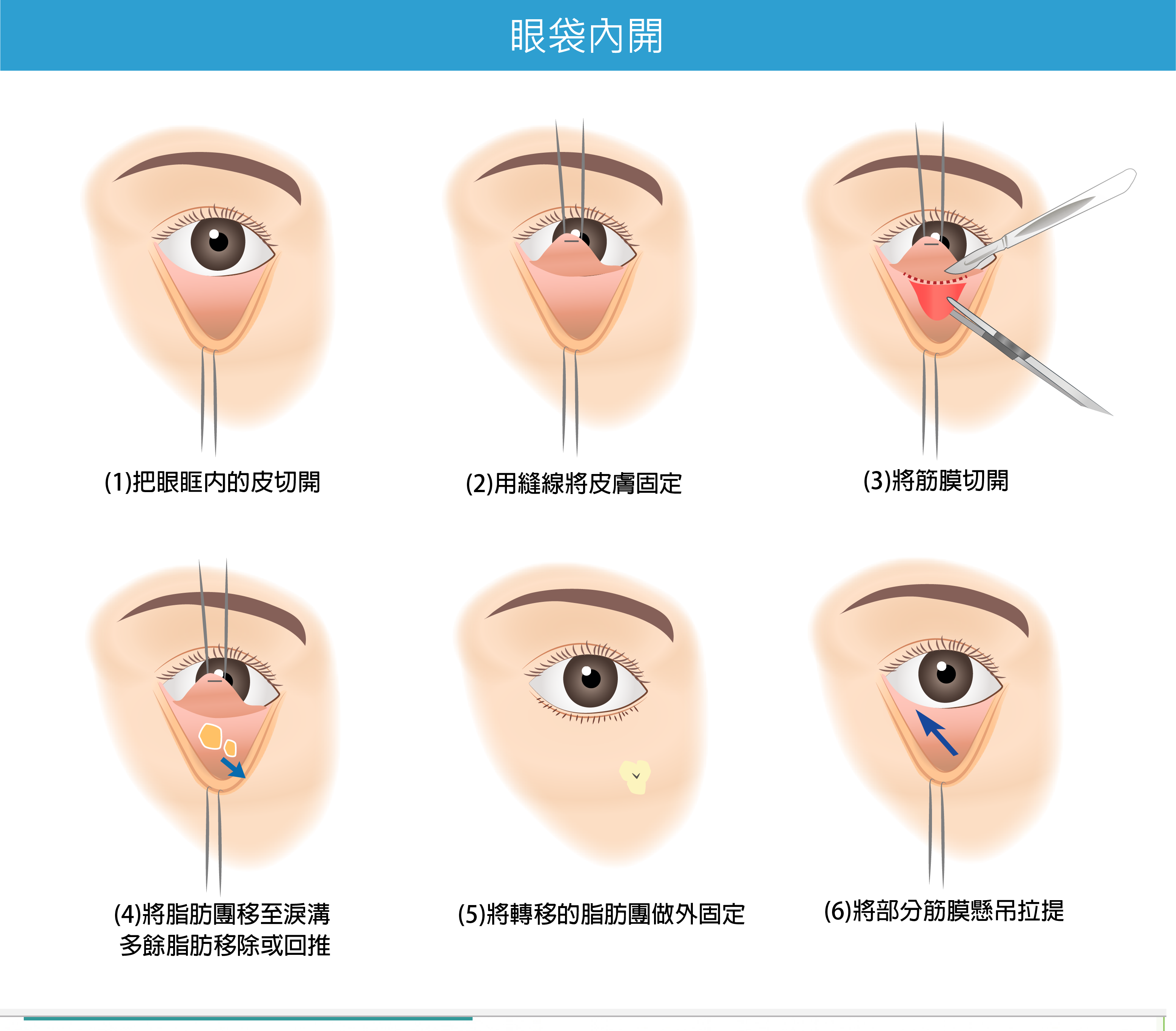 高雄醫美,高雄眼袋,眼袋內開,眼袋外開,高雄雙眼皮,高雄抽脂