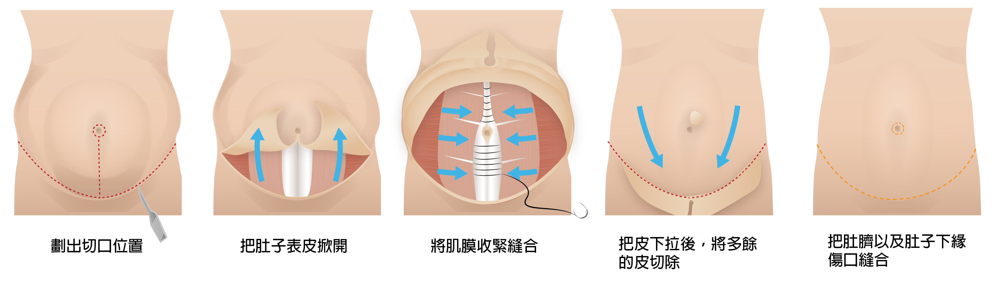 高雄醫美,高雄抽脂,高雄雙眼皮,高雄眼袋,高雄隆乳.高雄拉皮手術,高雄拉皮手術推薦,拉皮手術價格,拉皮手術權威,高雄拉皮手術,專業拉皮,拉皮費用價格,拉皮後遺症