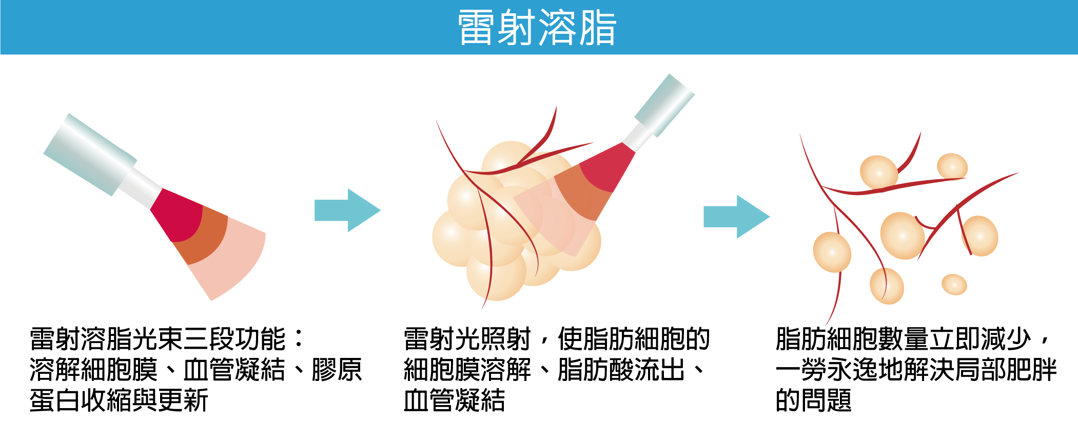 高雄抽脂,高雄醫美,高雄雷射溶脂,高雄抽脂推薦.png