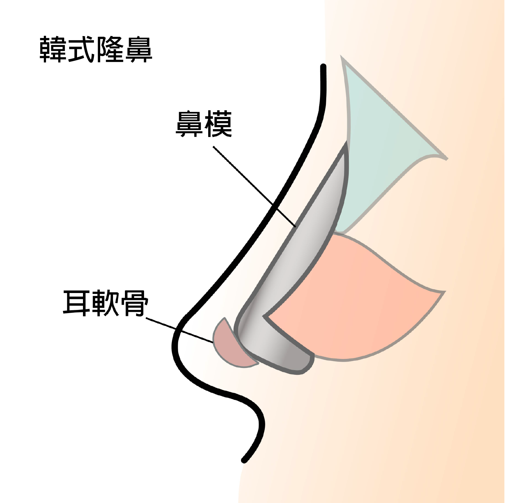 高雄韓式隆鼻,韓式隆鼻費用,高雄隆鼻手術,高雄鼻頭手術,高雄雙眼皮,高雄醫美推薦