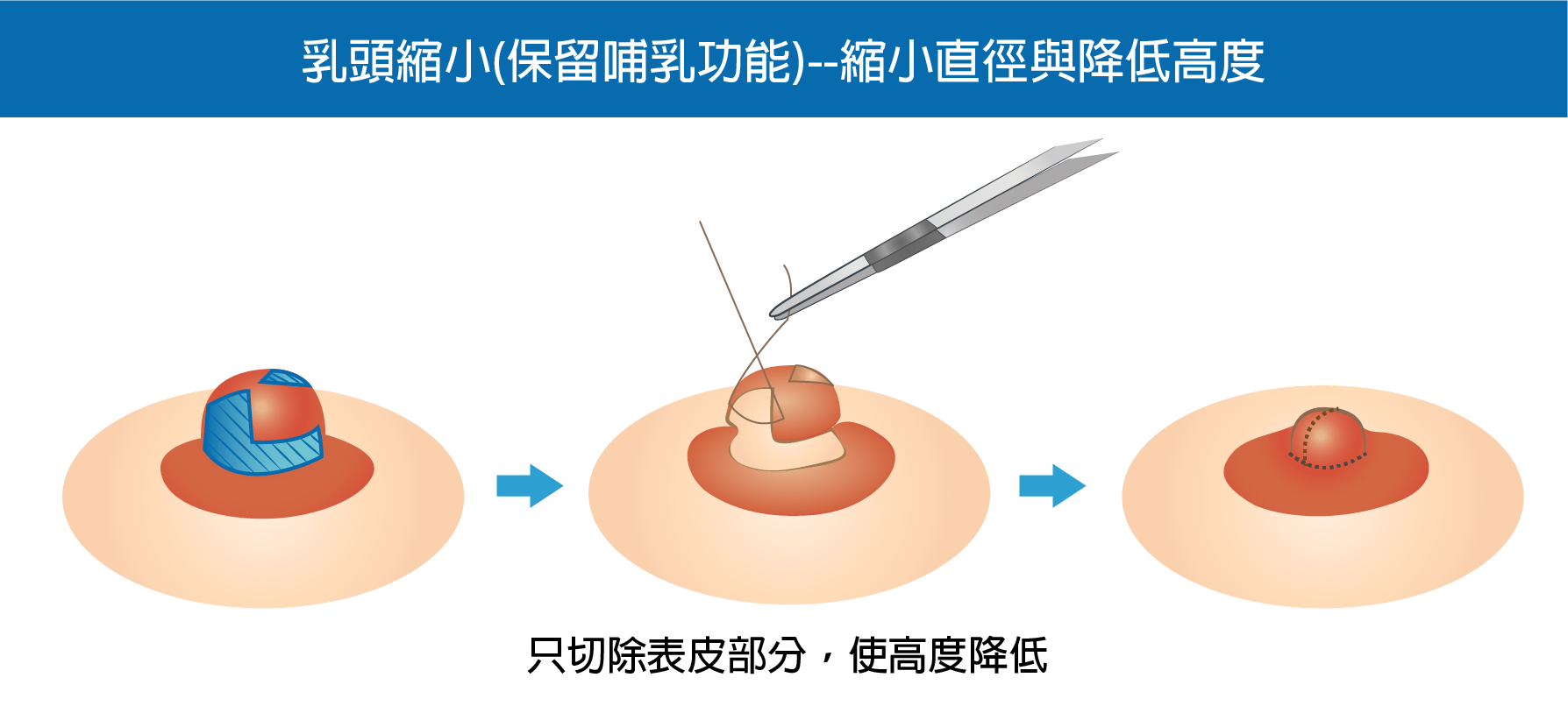 高雄乳頭縮小,乳頭矯正,乳頭縮小價格,高雄胸部整形,男性女乳,高雄醫美