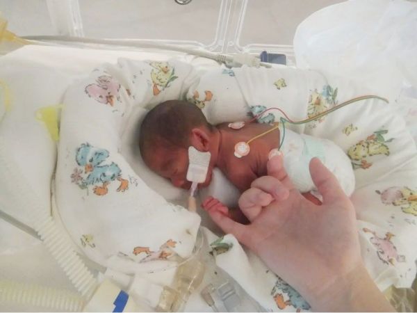 生後2週間のころの次女。妊娠25週772gで生まれ、NICUに入院していました