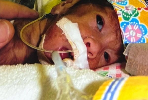 NICUに入院中の但馬芽吹さん