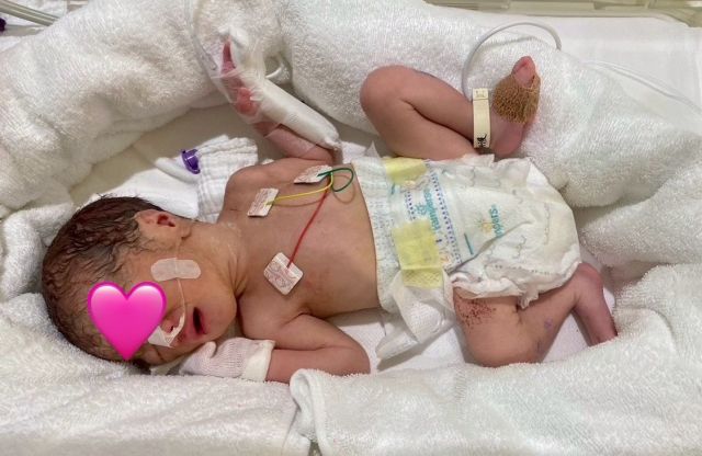 妊娠34週で生まれた長女