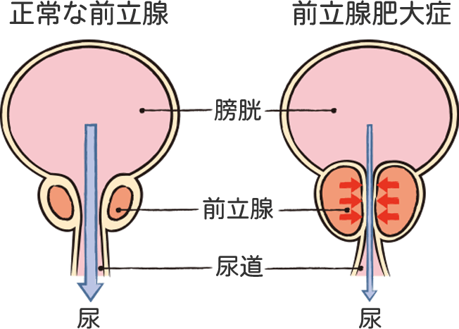 前立腺が肥大化する前立腺肥大症